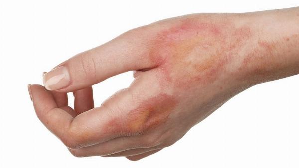 Trị sẹo bỏng tại nhà