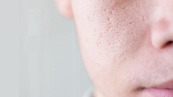 Hình ảnh sẹo đáy nhọn trên da