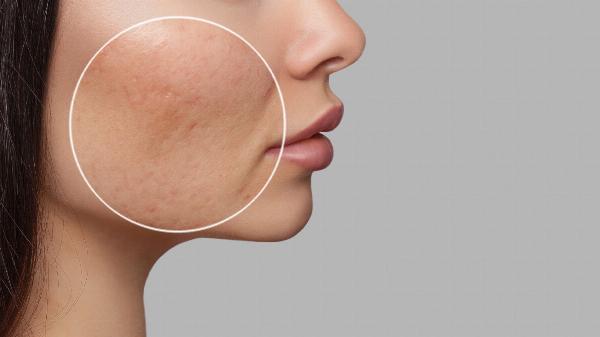 Sẹo đáy nhọn ở giữa an đường và phương pháp điều trị