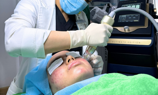 Điều trị sẹo đáy tròn bằng Laser Fractional CO2.