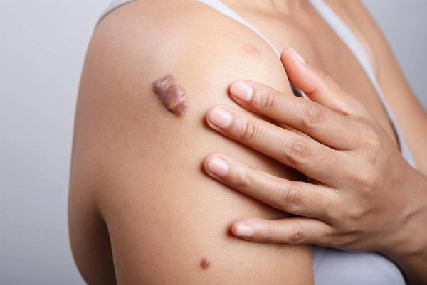 Sẹo lồi do mụn trứng cá hình thành qua nhiều giai đoạn phức tạp.