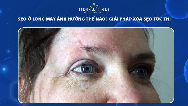 Sẹo ở lông mày có mọc lại được không, giải pháp và phương pháp điều trị