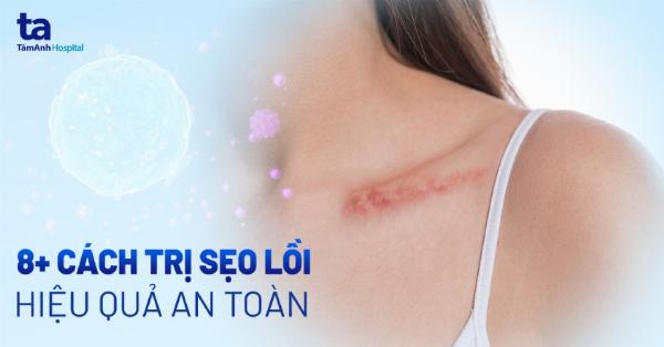 Điều trị sẹo vết mổ tử cung bằng laser