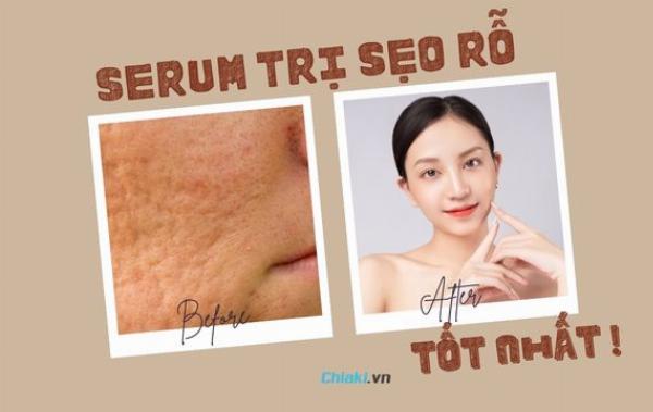So sánh kem trị sẹo rỗ Genie với các phương pháp điều trị sẹo rỗ khác như laser, lăn kim, PRP