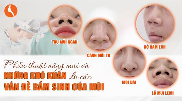 Hình ảnh minh họa mũi gồ trước và sau khi phẫu thuật sửa gồ để dễ hình dung sự thay đổi