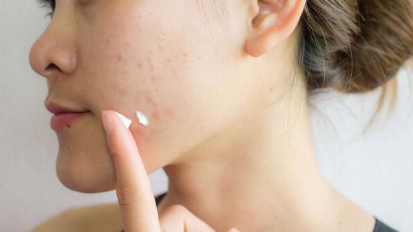 Niacinamide không thể điều trị sẹo rỗ vì không tái tạo collagen và elastin ở lớp hạ bì