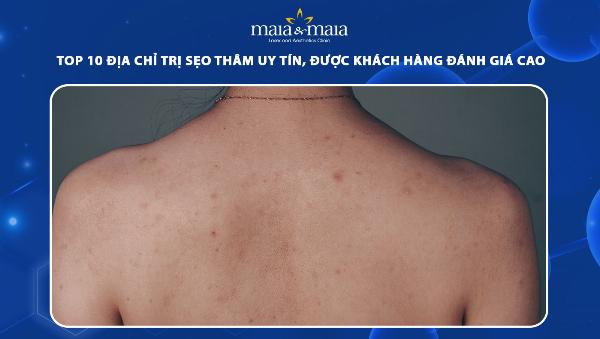 Thẩm mỹ viện Phú Xuân địa chỉ trị sẹo lõm uy tín và chất lượng hàng đầu