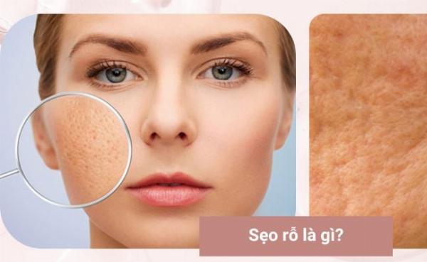 Thành phần retinoid trong kem trị sẹo đáy nhọn, có tác dụng kích thích sản sinh collagen và tái tạo da.