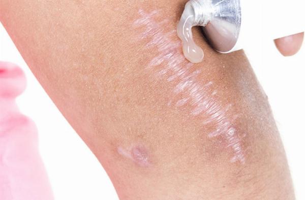 Thành phần vàng trong kem trị sẹo lồi vùng kín giúp cải thiện tình trạng sẹo