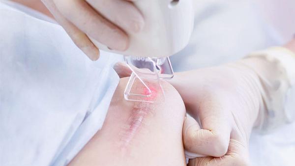 Điều trị sẹo lâu năm bằng công nghệ cao