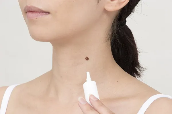 bác sĩ tư vấn và hướng dẫn chăm sóc da sau khi phá nốt ruồi