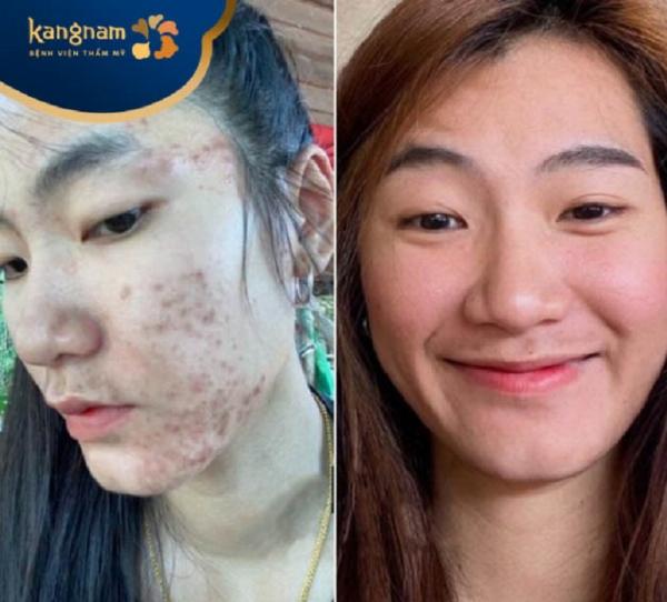 Liên hệ Thẩm mỹ viện Phú Xuân để được tư vấn liệu trình trị sẹo lõm cá nhân hóa.