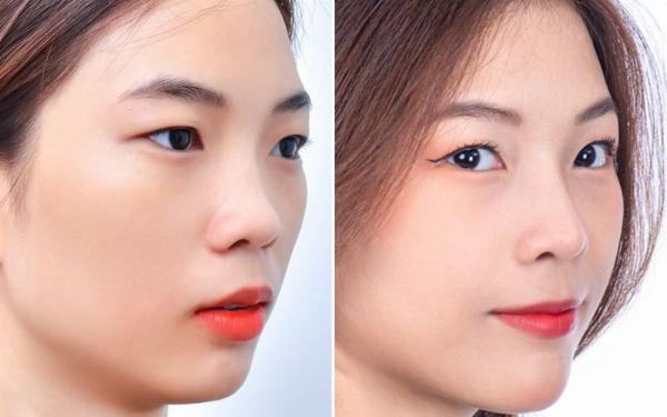 Bảng so sánh ưu nhược điểm của tiêm nâng mũi bằng filler.