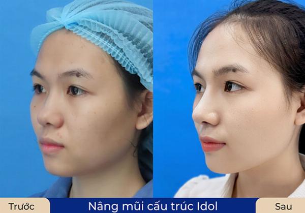 Sử dụng vật liệu đệm sinh học Megaderm khi nâng mũi da mỏng