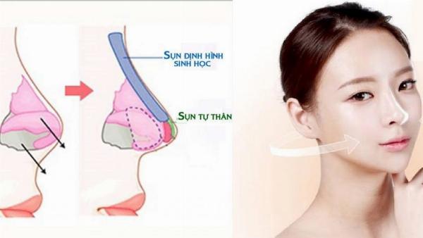 Cac loai sun thuong dung trong nang mui